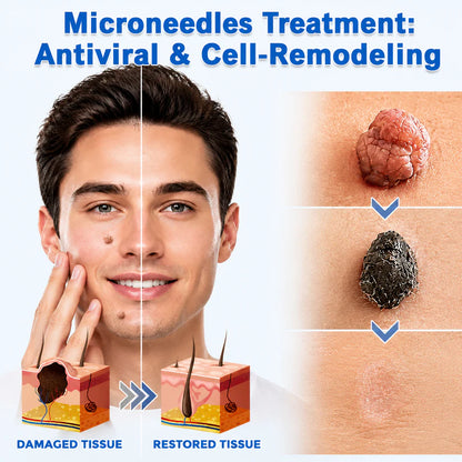 ✨2-in-1 Microneedle & Hydrocolloid Patch🍀